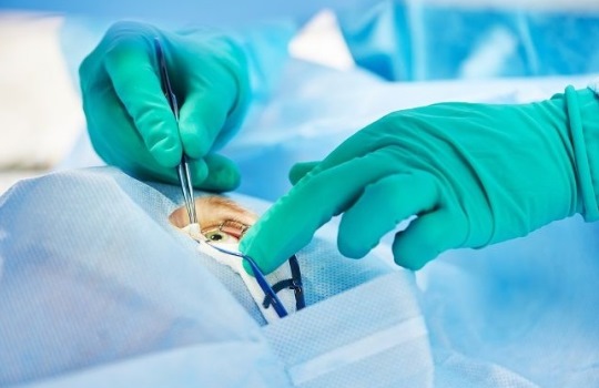 Mengenal LASIK Prosedur, Kelebihan, Risiko dan Komplikasi